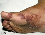 kaposi's sarcoma