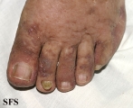 kaposi's sarcoma
