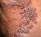 kaposi's sarcoma
