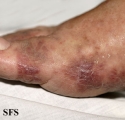 kaposi's sarcoma