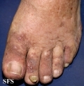 kaposi's sarcoma
