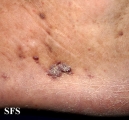 kaposi's sarcoma