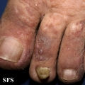 kaposi's sarcoma