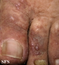 kaposi's sarcoma