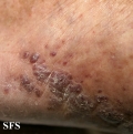 kaposi's sarcoma
