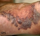 kaposi's sarcoma