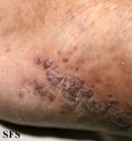 kaposi's sarcoma