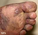 kaposi's sarcoma