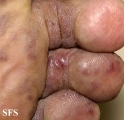kaposi's sarcoma