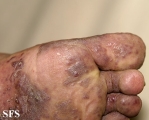 kaposi's sarcoma