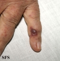 kaposi's sarcoma