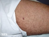 kaposi's sarcoma