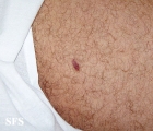 kaposi's sarcoma