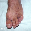 kaposi's sarcoma