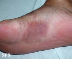 kaposi's sarcoma