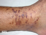 kaposi's sarcoma