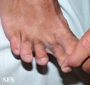 kaposi's sarcoma