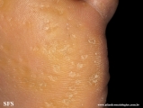 palmoplantar_keratoderma-punctate_type