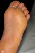 palmoplantar_keratoderma-punctate_type
