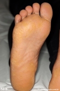 palmoplantar_keratoderma-punctate_type