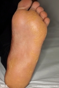 palmoplantar_keratoderma-punctate_type