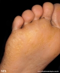 palmoplantar_keratoderma-punctate_type