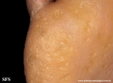 palmoplantar_keratoderma-punctate_type