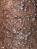 lichen amyloidosus