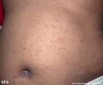 scabies