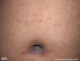 scabies