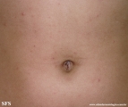 scabies
