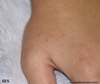 scabies