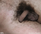 scabies
