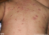 scabies