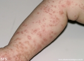 scabies