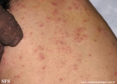 scabies