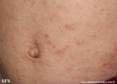 scabies