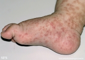 scabies