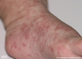 scabies