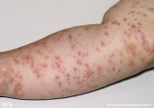 scabies