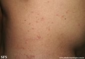 scabies