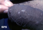 scabies