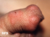 scabies