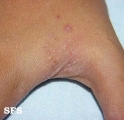 scabies