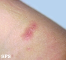 scabies