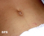 scabies