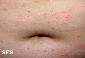 scabies