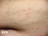 scabies