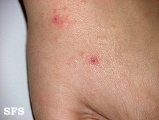 scabies