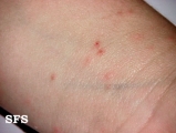 scabies